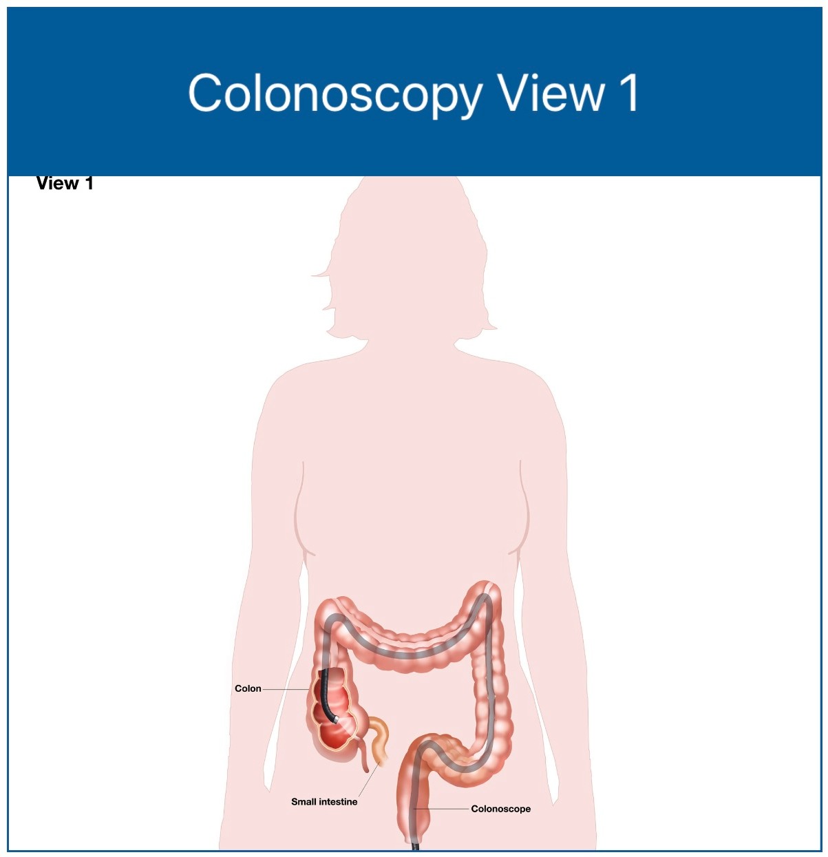 Colonoscopy View 1