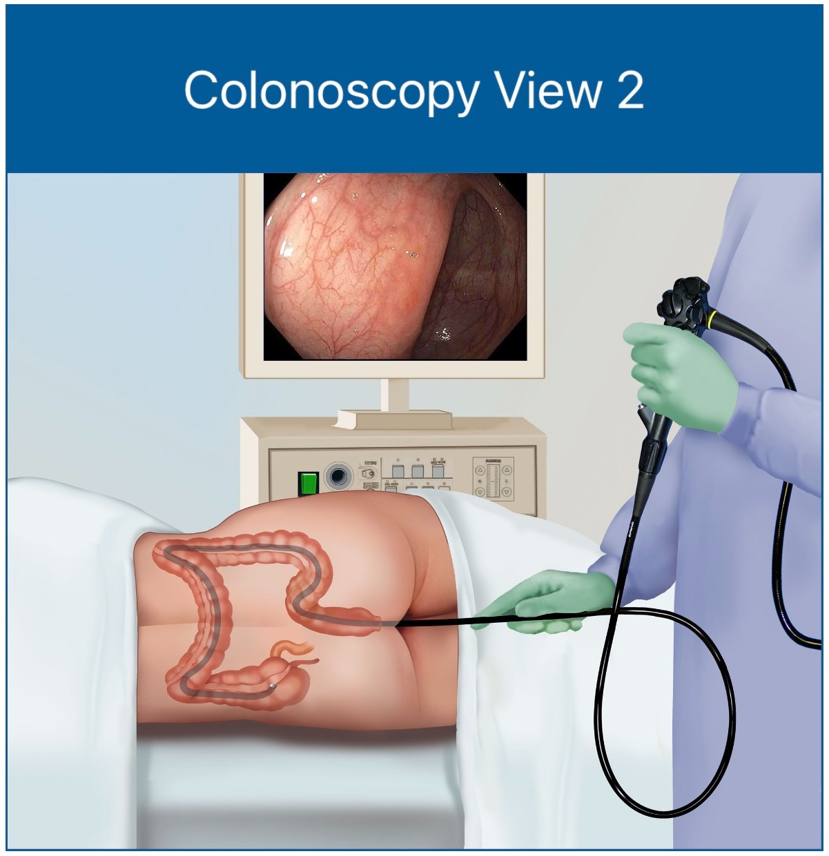 Colonoscopy View 2